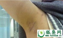 患上腋臭后会有哪些症状出现