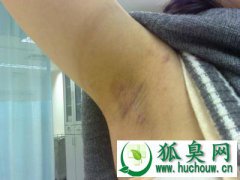 得了狐臭怎么办 盘点狐臭的保守疗法