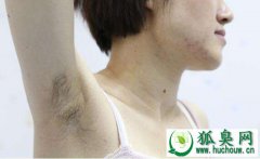 狐臭怎么治疗是最好 总结有效治狐臭的四个方法